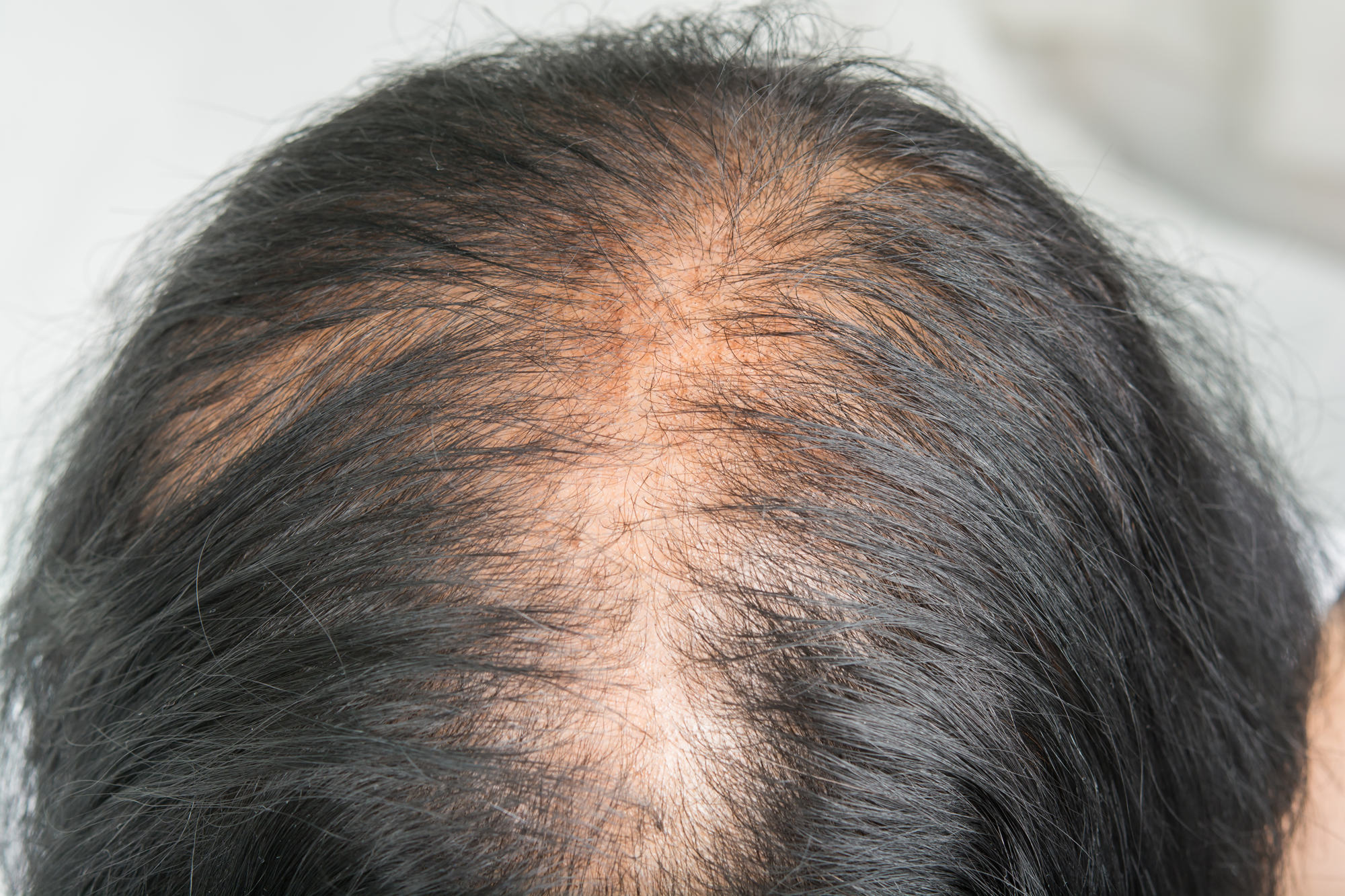 Hair loss in women can be devastating and you feel like you have lost your identity. We do have a solution for you here at Image Design Studio.  There are a variety of reasons to why this happens to women, genetics in your DNA, hormonal imbalances illness